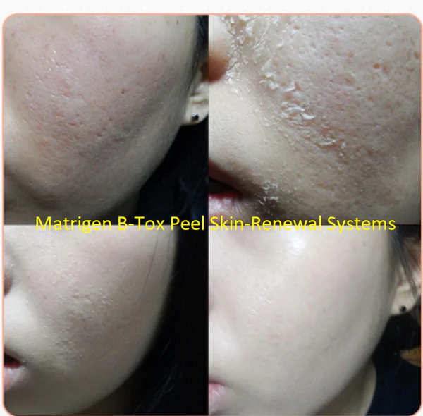 Matrigen B-TOX Peel Skin Renewal System